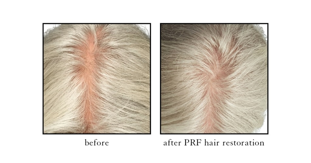 Effective treatments for thinning hair -PRF injections | RegenCen