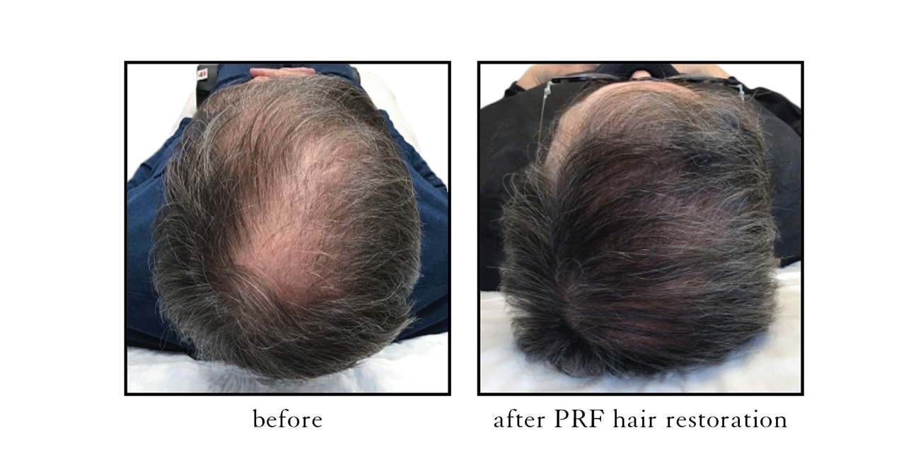 PRF-hair-restoration-5-1 PRF-hair-restoration-5-1