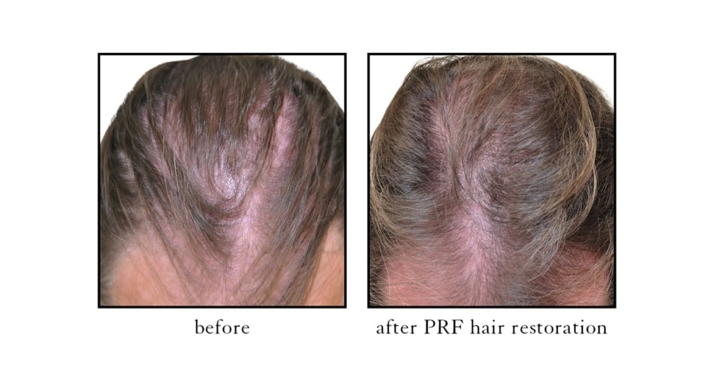 PRF-hair-restoration2