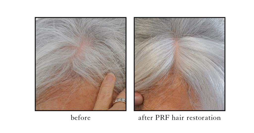 PRF-hair-restoration3