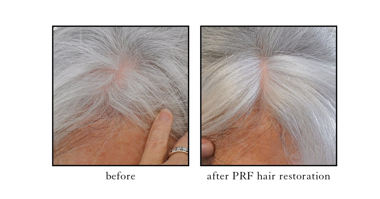 PRF-hair-restoration3 PRF-hair-restoration3